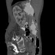 Gastric folds, prominent: CT - Computed tomography